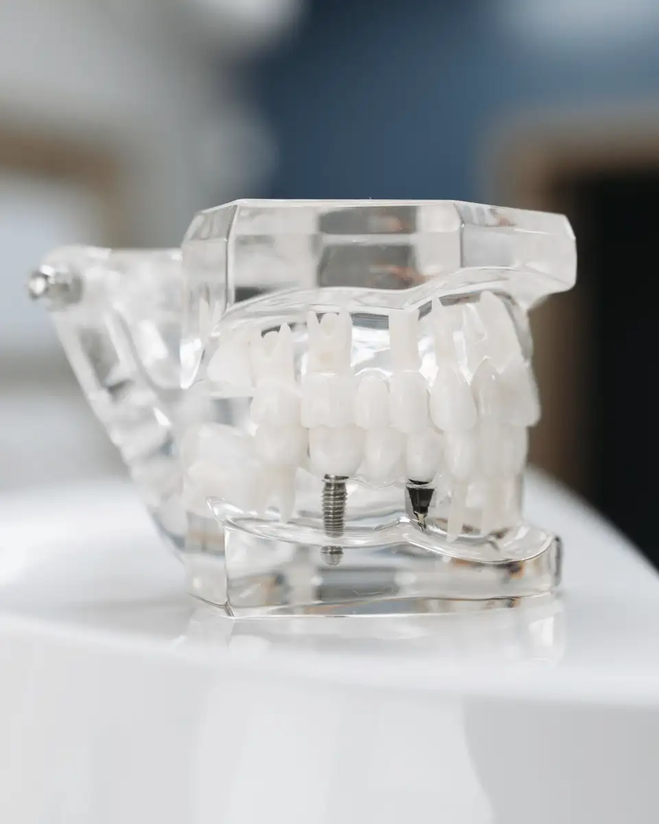 Clear teaching model of a full jaw with implant screws visible inside