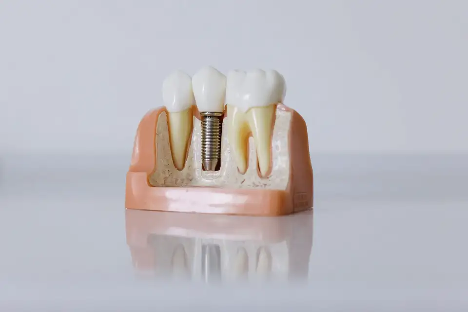 Teaching model of a jaw with a single implant post between natural teeth